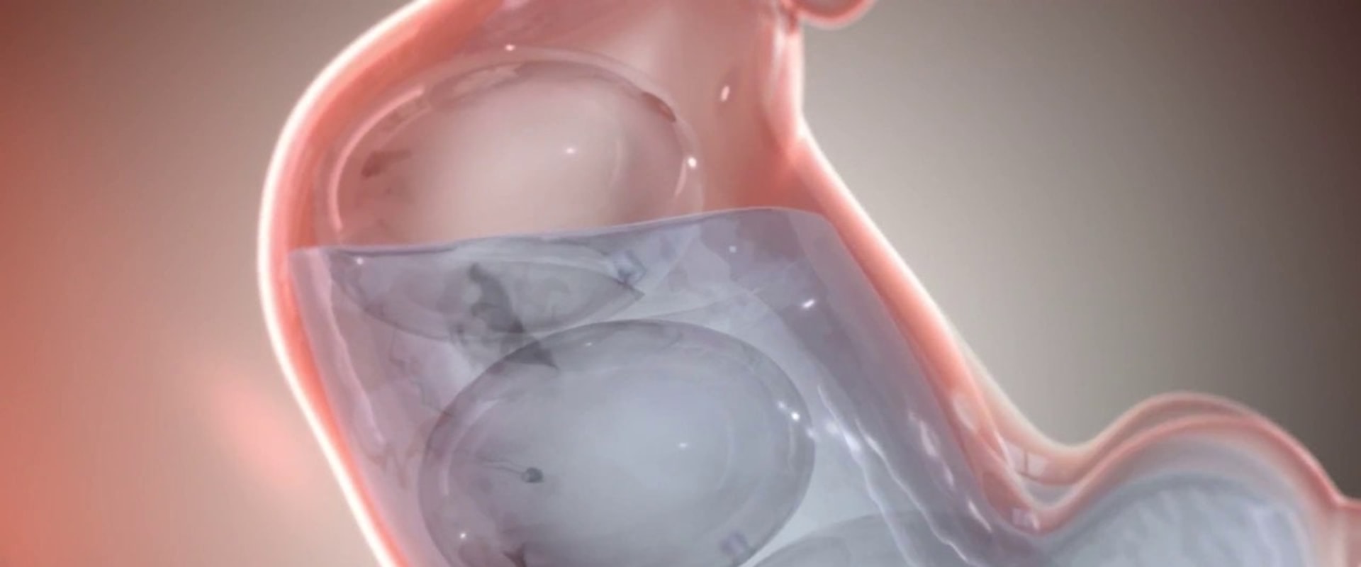 Intragastric Balloon Treatment: Everything You Need to Know