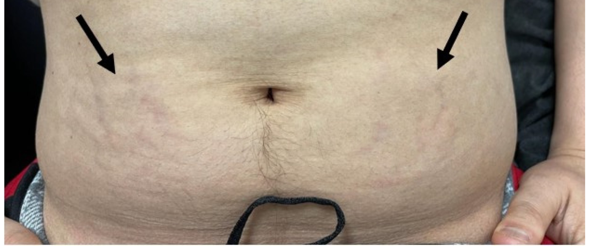 Cushing's Syndrome and Obesity: Causes, Symptoms, and Treatment