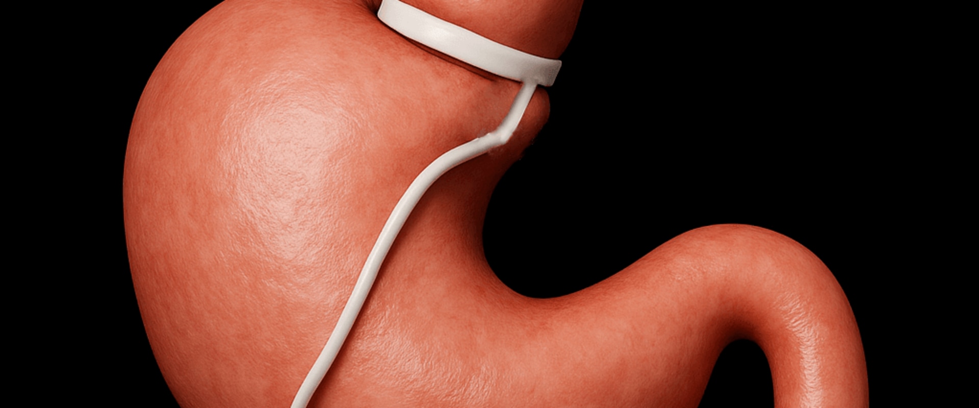 Gastric Banding Surgery: An Overview