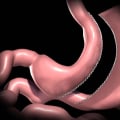 Gastric Banding Surgery: An Overview