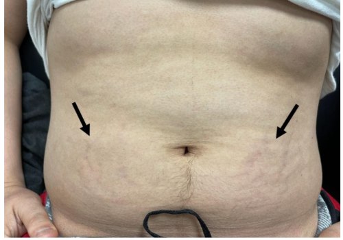 Cushing's Syndrome and Obesity: Causes, Symptoms, and Treatment