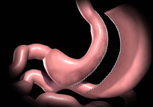 Gastric Banding Surgery: An Overview